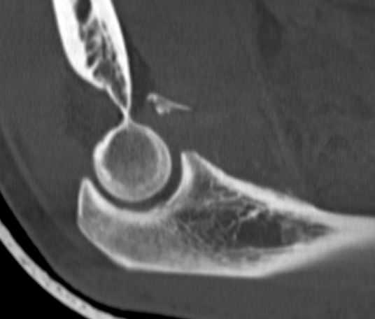 Coronoid Fracture Type 2